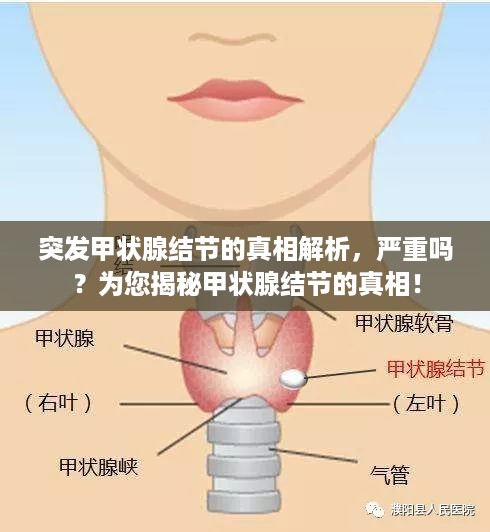 突发甲状腺结节的真相解析，严重吗？为您揭秘甲状腺结节的真相！