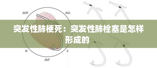 突发性肺梗死：突发性肺栓塞是怎样形成的 
