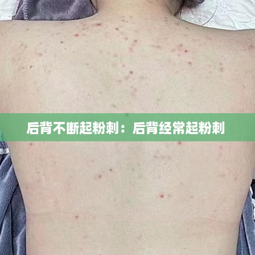 后背不断起粉刺：后背经常起粉刺 