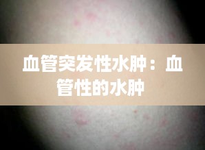 血管突发性水肿：血管性的水肿 